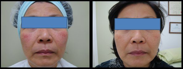 Before and after Clearlift