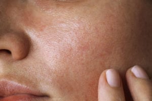 Sun spot blemishes removal