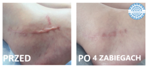 Scar removal