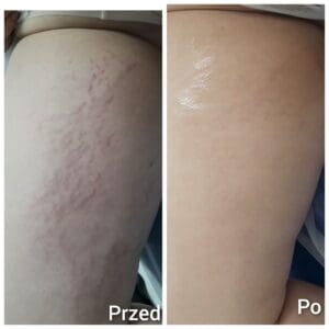 strech marks removal