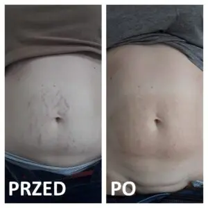 Удаление растяжек