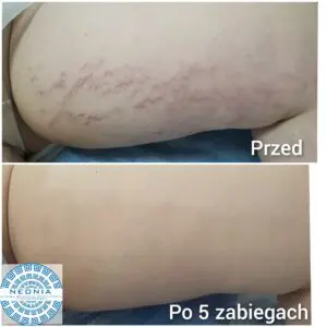 strech marks removal