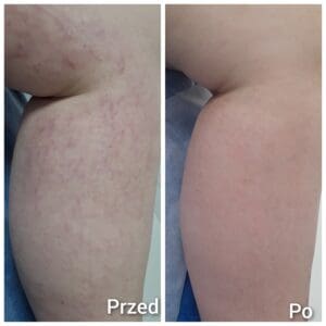 Usuwanie rozstępów efekty