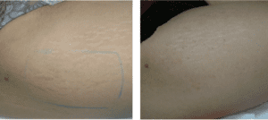 Usuwanie starych rozstępów