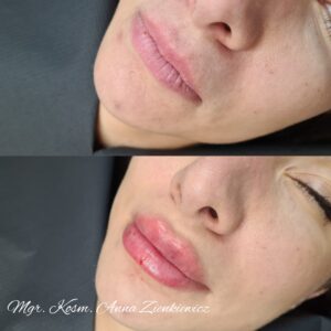 powiększanie ust