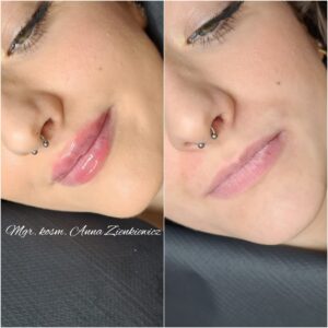 powiększanie ust Kraków