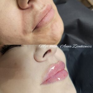 powiększanie ust przed i po