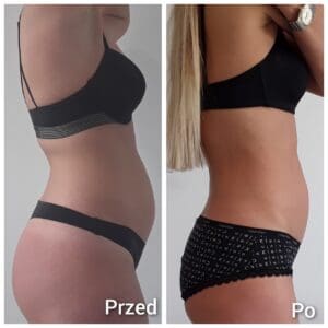 Hifu Efekty przed i po na ciało