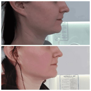 Hifu Policzki przed i po