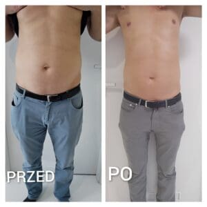 Hifu przed i po