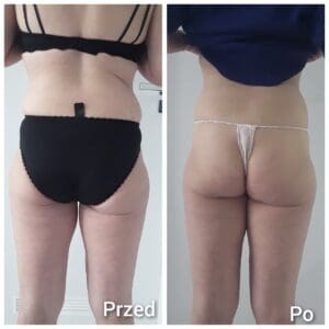 Kriolipoliza zdjęcia przed i po