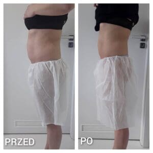 Kriolipoliza zdjęcia przed i po Kraków