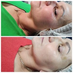 Radiofrekwencja mikroigłowa Kraków przed i po