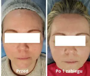 Rf mikroigłowa przed i po