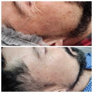 dermapen Kraków Efekty