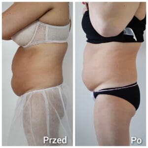 kriolipoliza brzuch efekty