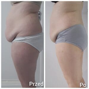 kriolipoliza brzuch przed i po