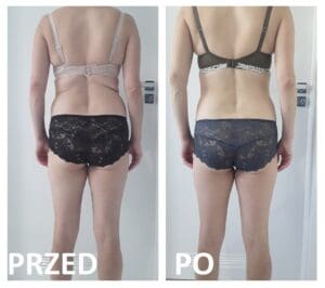 kriolipoliza efekty zabiegu