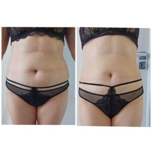 kriolipoliza przed i po