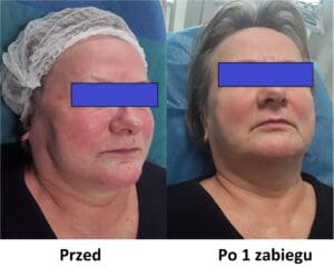 leczenie trądziku różowatego