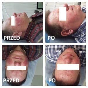 leczenie trądziku różowatego efekty