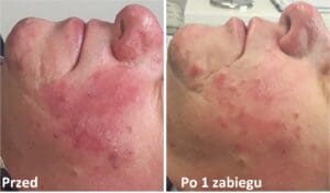 trądzik różowaty efekty zabiegu