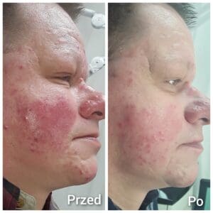 trądzik różowaty leczenie laserem