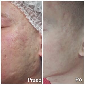 usuwanie blizn po trądziku efekty