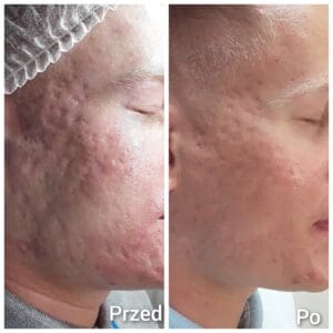 usuwanie blizn potrądzikowych Kraków