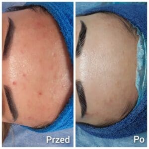 usuwanie brwi permanentnych