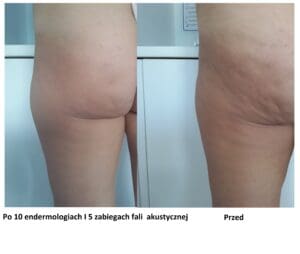 usuwanie cellulitu efekty