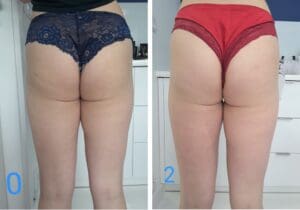 usuwanie cellulitu zdjęcia przed i po